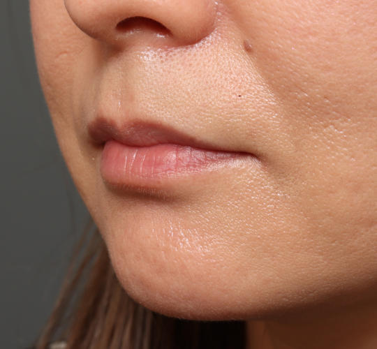 40代女性のヒアルロン酸注射（唇） Before 症例写真