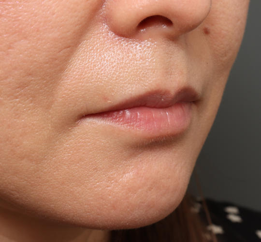 40代女性のヒアルロン酸注射（唇） Before 症例写真