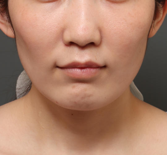 30代女性の人中短縮（リップリフト） After 症例写真