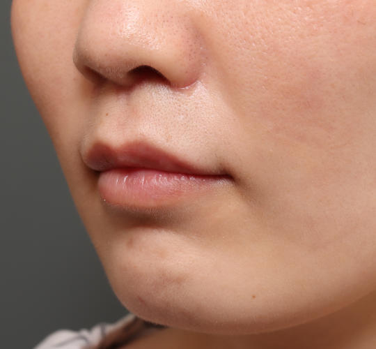 30代女性の人中短縮（リップリフト） After 症例写真