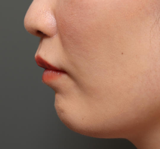 30代女性の人中短縮（リップリフト） After 症例写真