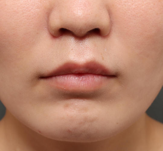 30代女性の人中短縮（リップリフト） After 症例写真