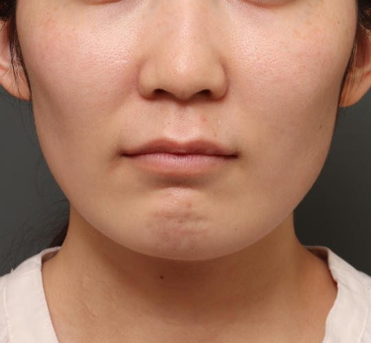 30代女性の人中短縮（リップリフト） Before 症例写真