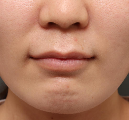30代女性の人中短縮（リップリフト） Before 症例写真