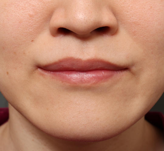 30代女性の唇・口元の整形 After 症例写真