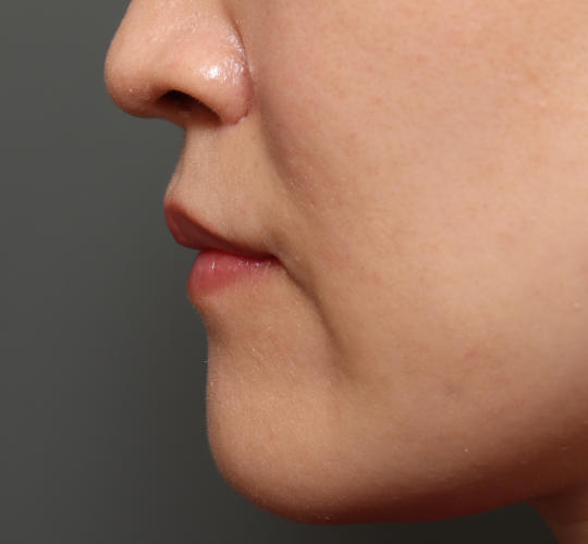 30代女性の人中短縮（リップリフト） After 症例写真