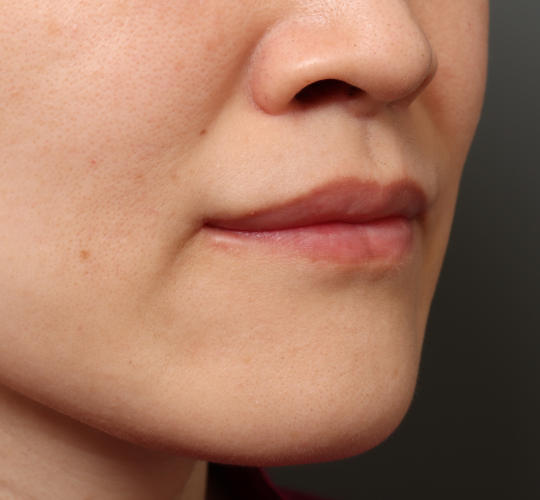 30代女性の人中短縮（リップリフト） After 症例写真