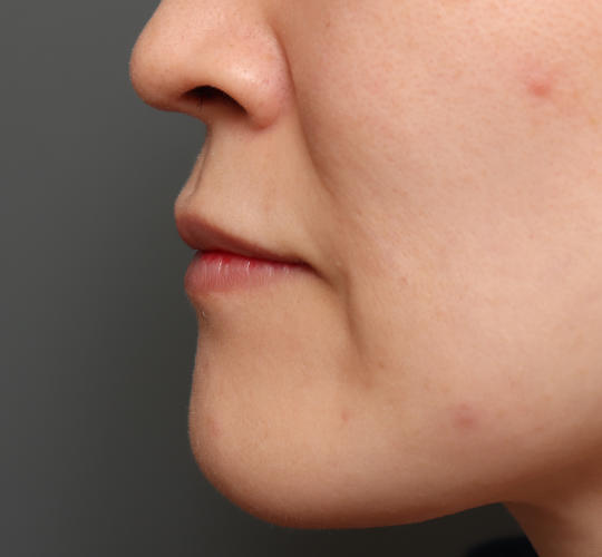 30代女性の人中短縮（リップリフト） Before 症例写真