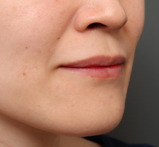30代女性の人中短縮（リップリフト） Before 症例写真