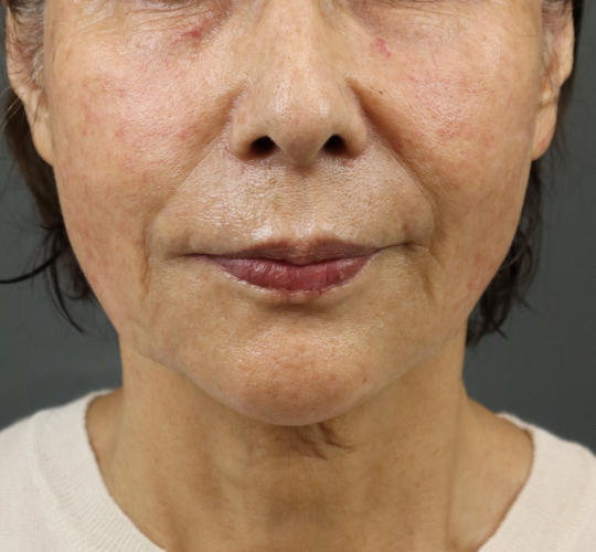 70代女性のスネコス After 症例写真