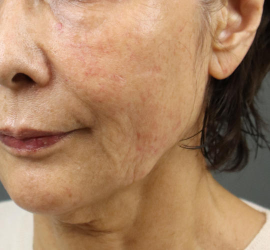 70代女性のシワ・たるみ After 症例写真