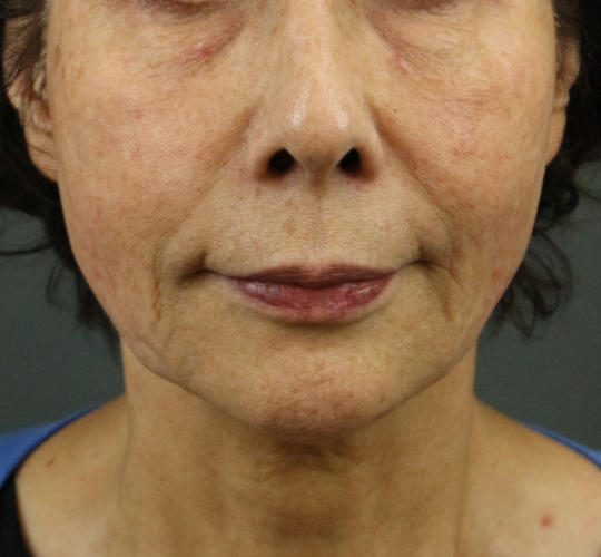 70代女性のスネコス Before 症例写真