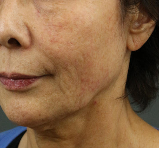 70代女性のシワ・たるみ Before 症例写真