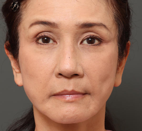 60代女性のチークリフト・フェイスリフト After 症例写真