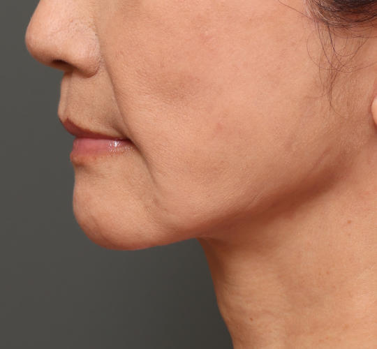 60代女性のチークリフト・フェイスリフト After 症例写真