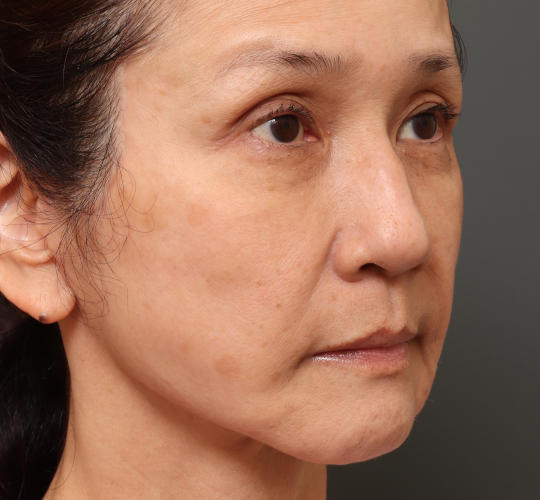 60代女性のチークリフト・フェイスリフト After 症例写真