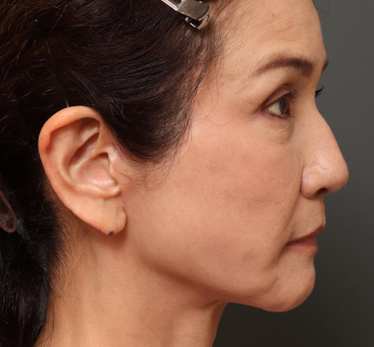 60代女性のチークリフト・フェイスリフト After 症例写真