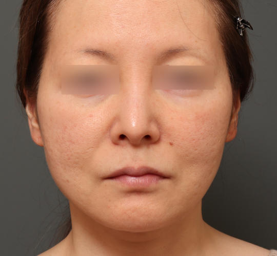 40代女性のスネコス Before 症例写真