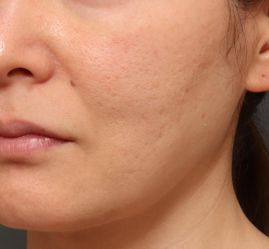 40代女性のシワ・たるみ Before 症例写真