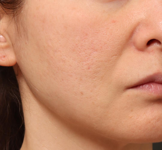 40代女性のスネコス Before 症例写真