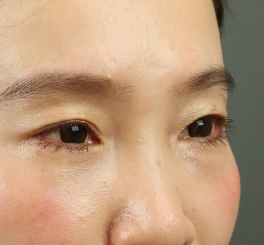 30代女性のアイスレッド After 症例写真