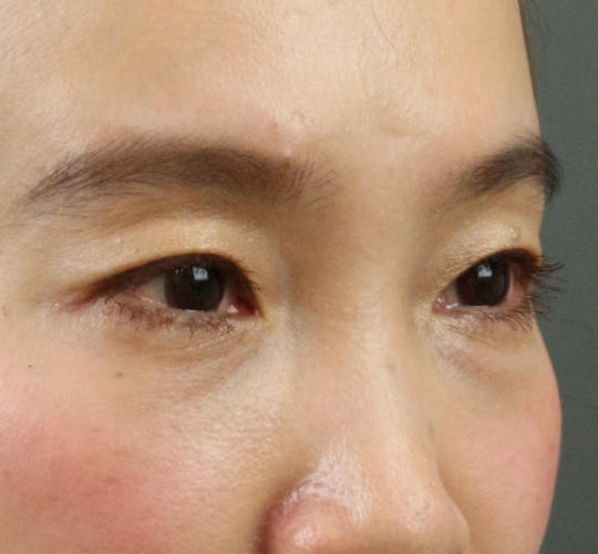 30代女性のアイスレッド Before 症例写真