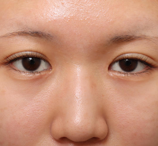 10代女性の目頭切開 After 症例写真