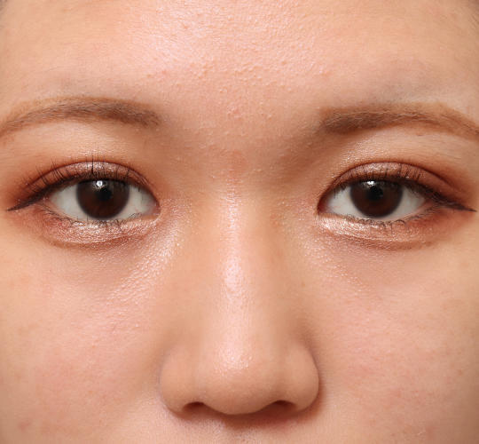 10代女性の二重埋没法 After 症例写真