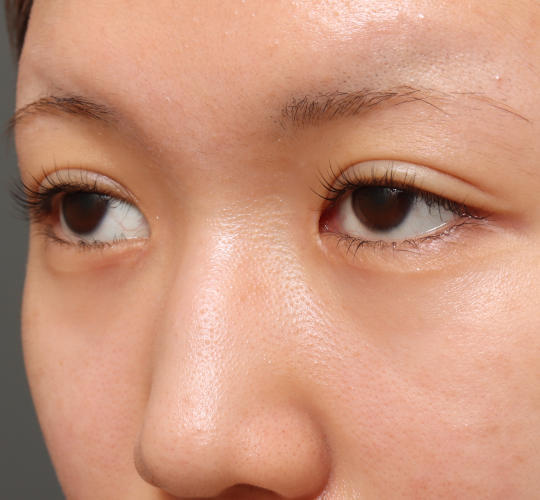 10代女性の二重埋没法 After 症例写真