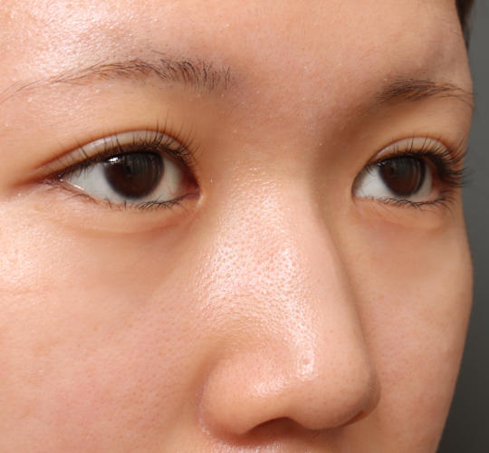 10代女性の二重埋没法 After 症例写真