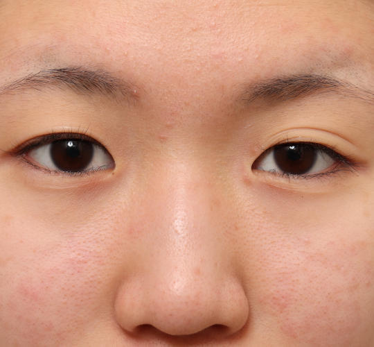 10代女性の目頭切開 Before 症例写真