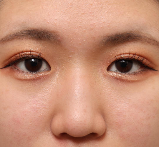 10代女性の二重埋没法 Before 症例写真