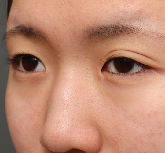 10代女性の二重埋没法 Before 症例写真