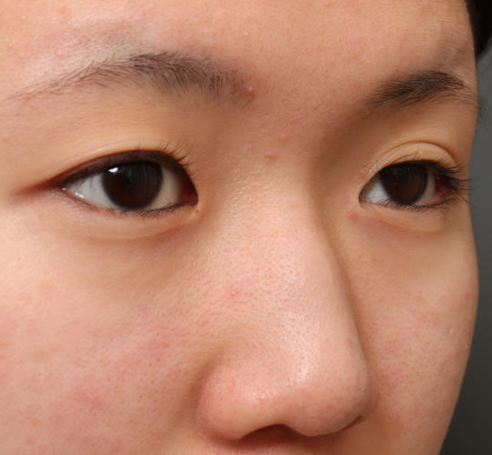 10代女性の二重埋没法 Before 症例写真