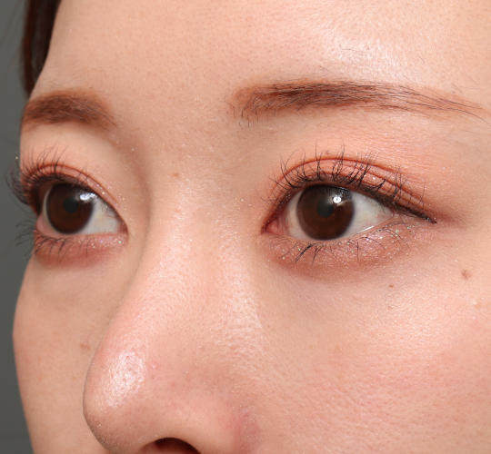 20代女性のタレ目・でか目形成 Before 症例写真