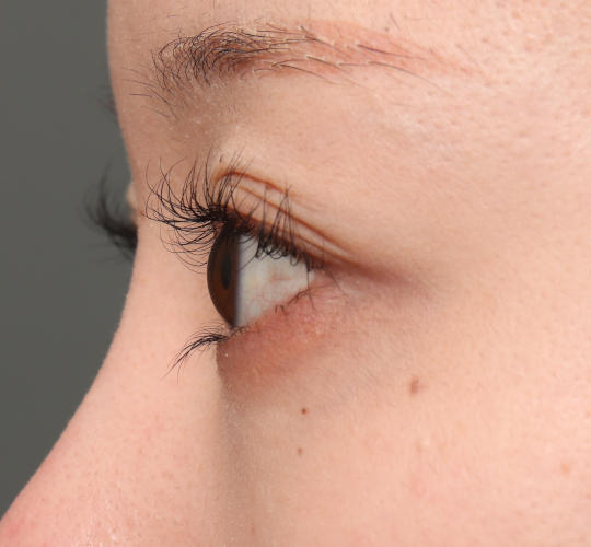 20代女性のタレ目・でか目形成 Before 症例写真