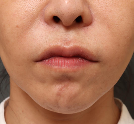 40代女性の人中短縮ボトックス After 症例写真