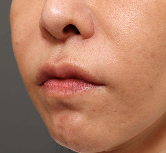 40代女性の人中短縮ボトックス After 症例写真