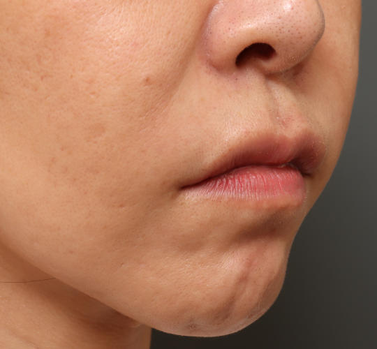 40代女性の人中短縮ボトックス After 症例写真