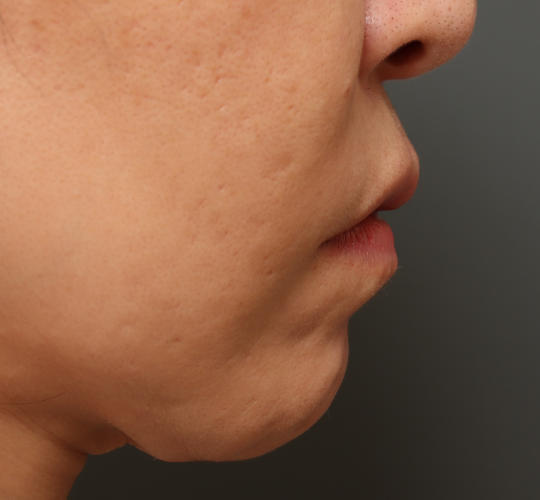 40代女性の人中短縮ボトックス After 症例写真