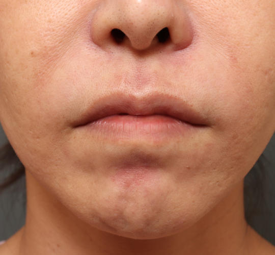 40代女性の人中短縮ボトックス Before 症例写真