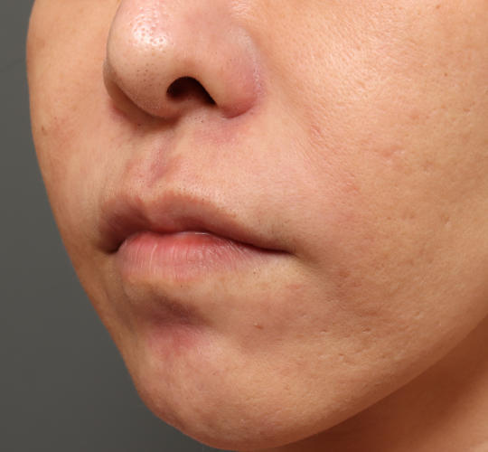 40代女性の人中短縮ボトックス Before 症例写真