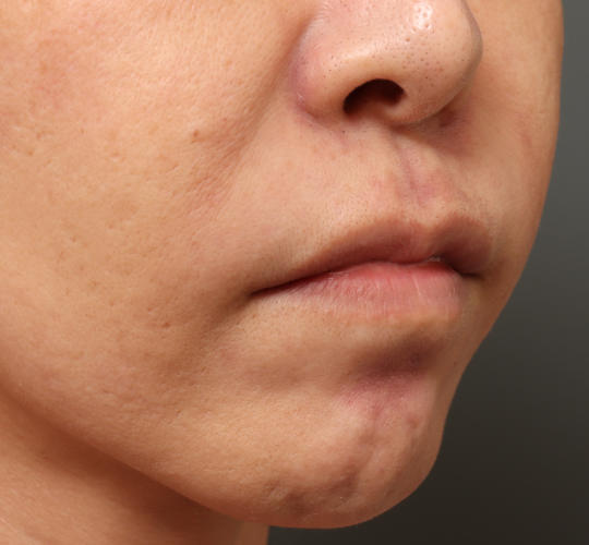 40代女性の人中短縮ボトックス Before 症例写真