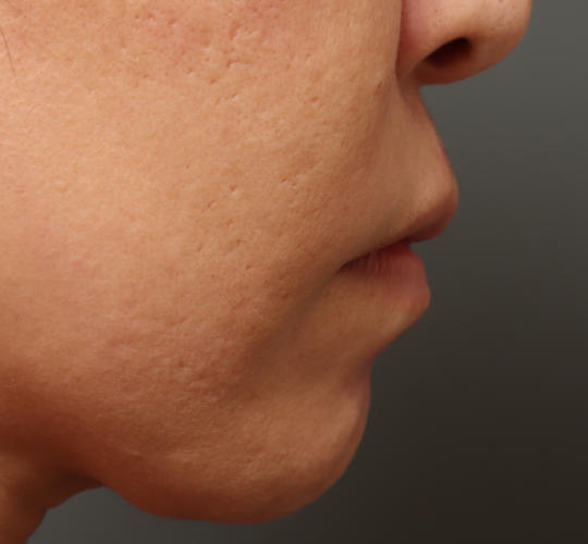 40代女性の人中短縮ボトックス Before 症例写真