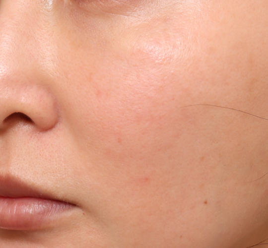 30代女性のレチノールダーマペン After 症例写真