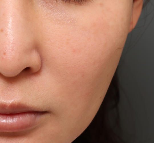 30代女性のレチノールダーマペン After 症例写真