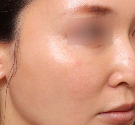 30代女性のレチノールダーマペン After 症例写真