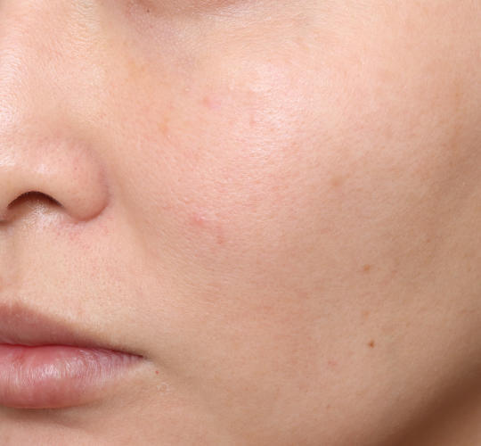 30代女性のレチノールダーマペン Before 症例写真