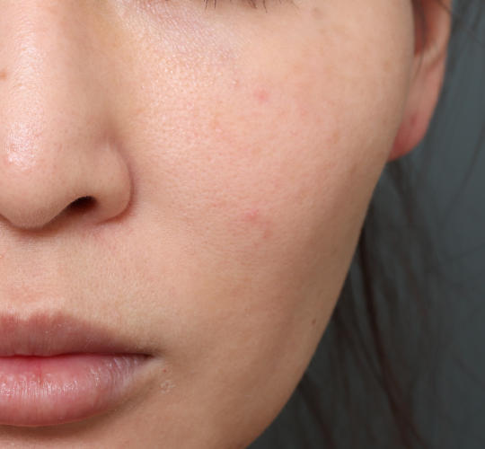 30代女性のレチノールダーマペン Before 症例写真