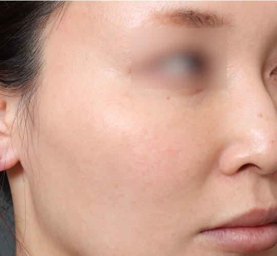 30代女性のレチノールダーマペン Before 症例写真